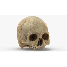 Real Human Skull Cranium with Leprosy 01 3D model